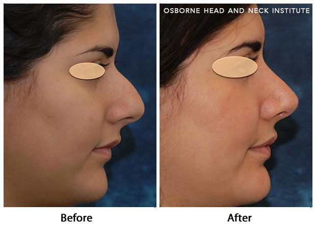 nose surgery los angeles